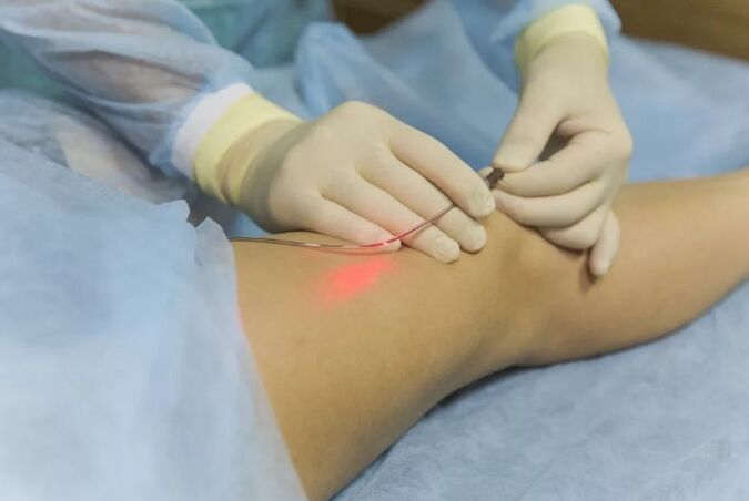 Tratamentul varicelor cu un laser