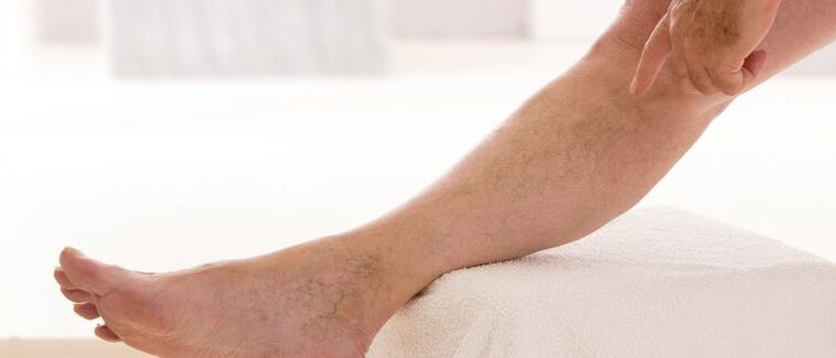 Vene varicoase pe picioare